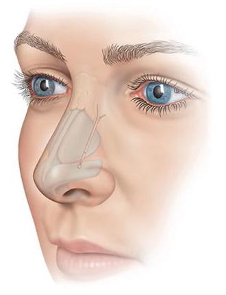 Nasal Obstruction